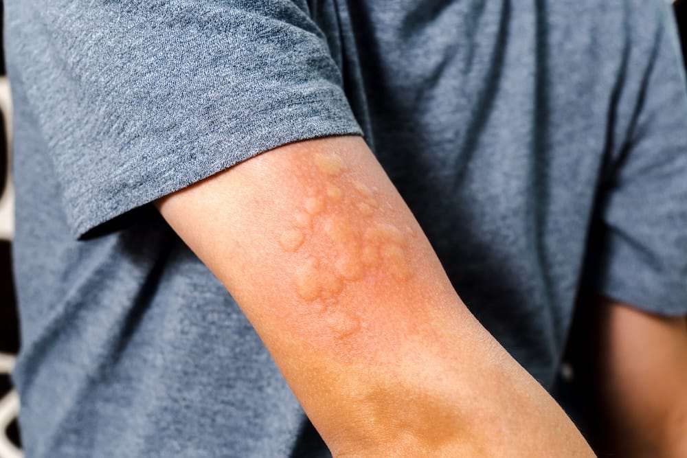 Allergist identifying hives from a serious skin allergy.
